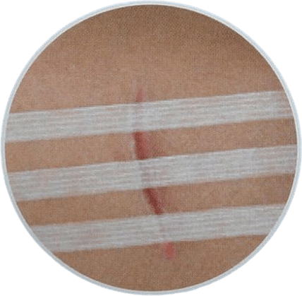 Steri-strip Suturtejp 6×7,5cm